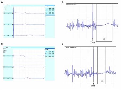 The Effects of Modified Constraint-Induced Movement Therapy in Acute Subcortical Cerebral Infarction